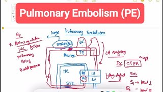 Pulmonary Embolism (PE) #Respiratory 32 | First Aid USMLE Step 1 in Urdu/Hindi |