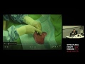 Live Case of Right Heart Catheterisation using Dynamic Exercise - Dr Katrina Adorini
