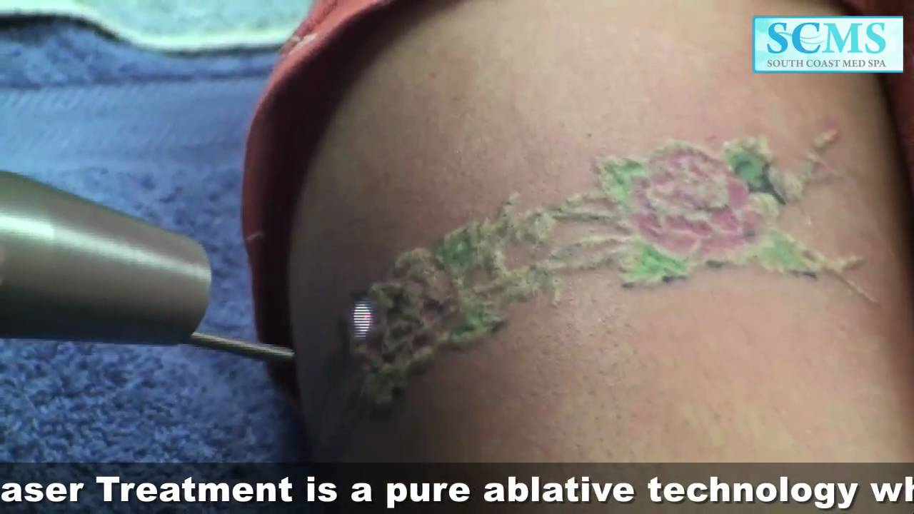 Orange County Tattoo Removal YouTube