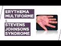 Erythema multiforme