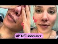 What Surgeons Don’t Tell You About Lip Lift Surgery