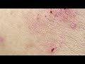 Extractions And Acne | Điều Trị Mụn - ThuyTruong#85