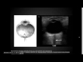 Ocular ultrasound:  "EM in 5"