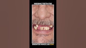 Missing Teeth Solution - Snap On Veneers #shorts #smiletransformation