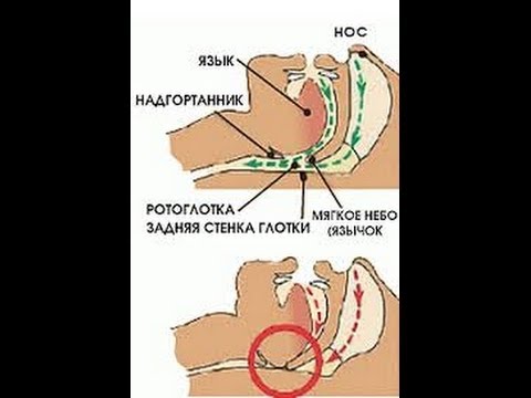 Как вылечить у мужа храп