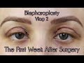 My Eyelid Surgery 1st Weeks of Recovery | Cosmetic Blepharoplasty Diary Part 2