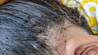 Why head lice are so hard to kill - Head lice removal from smooth hair