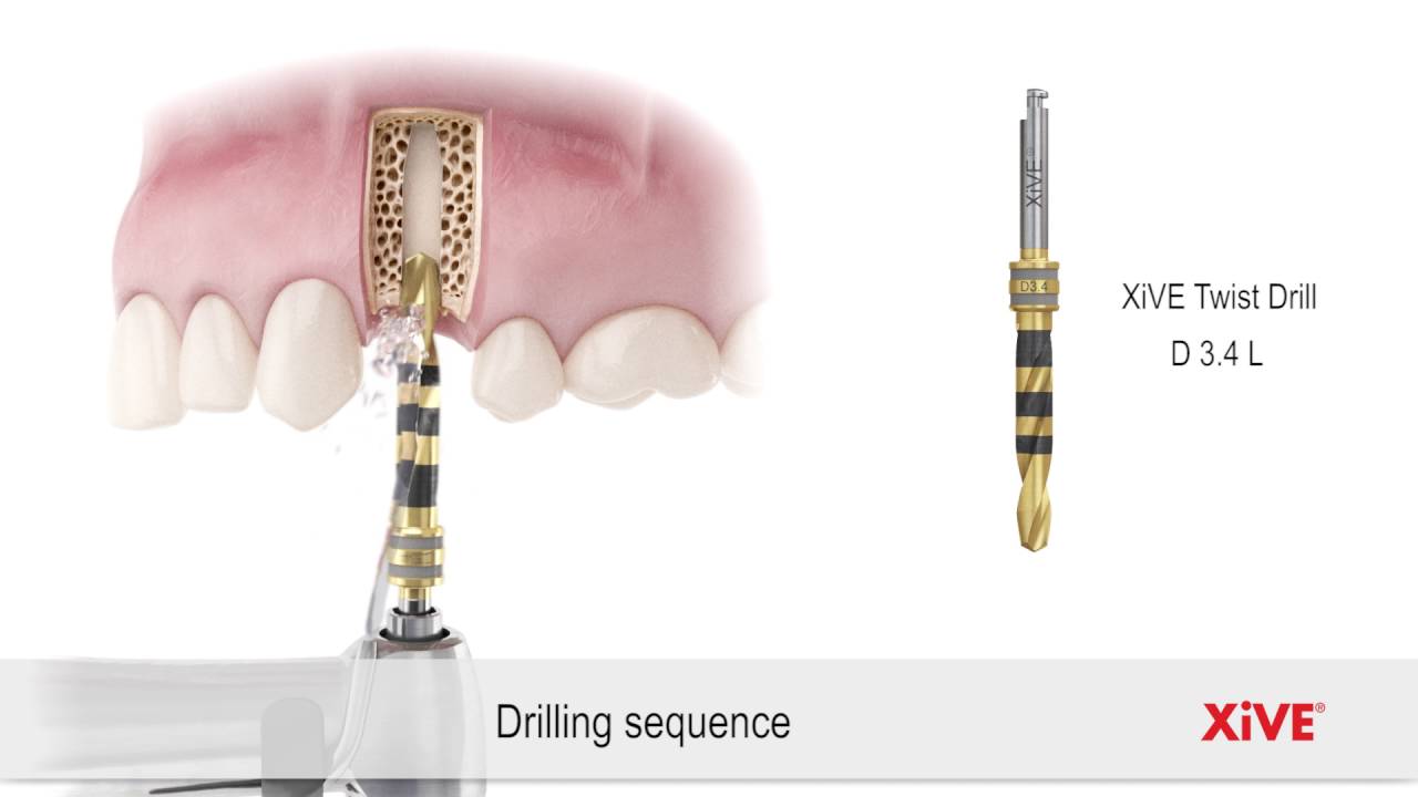 Xive Drilling sequence and implant placement YouTube