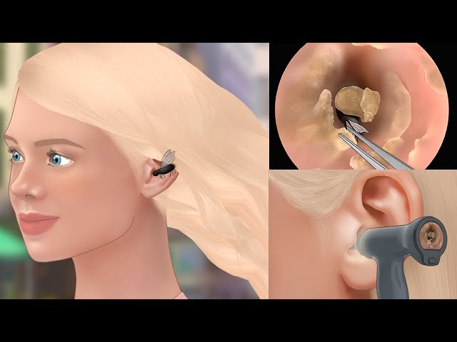 ASMR Satisfying! Bug removal & ear cleaning animation | tingle sound -  YouTube