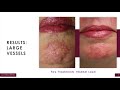 Dr Nina Wines - Laser for Red Spots, Broken Vessels, Redness