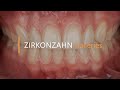 Minimally invasive restoration using zirconia veneers | Zirkonzahn.Galleries