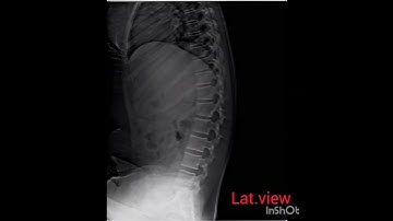 dorsal lumbar spine x ray #xrayclasses #radiography #x ray#digitalxray #CRx-ray