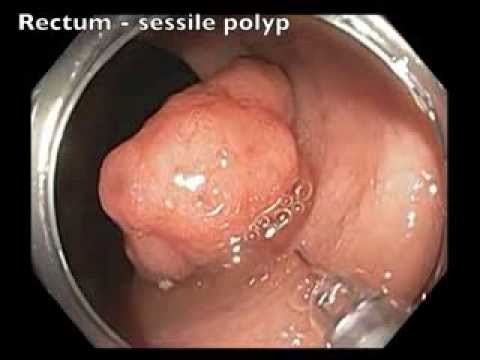 rectal polypectomy