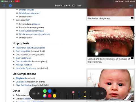 רפואת עיניים - לימוד משותף - דלקת עפעפיים - Blepharitis