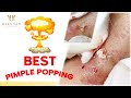 Best Pimple Popping! Điều trị mụn hiệu quả nhất TPHCM tại Hiền Vân SpaI Trần Xuân Trường I Bài 418