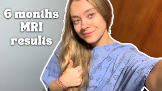 6 Months After Brain Surgery | MRI results + health update