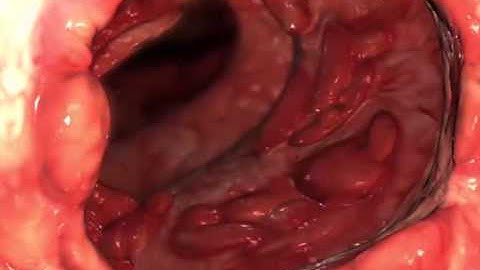 Learn@Visible Body - Ulcerative Colitis