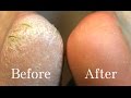 HOME REMEDIES FOR CRACKED HEELS  | REMOVE CRACKED HEELS FAST AND EASYLY AT HOME  (live demo)