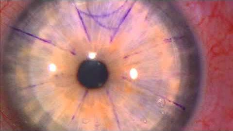 LASIK - Dr. J.S. Lewis - Anatomy of a SBK flap - MORIA - EN