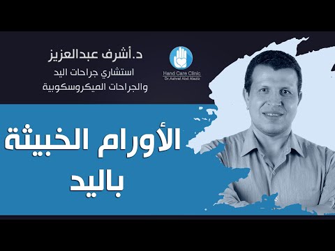 هل في أورام خبيثة باليد هو مرض نادر ما هي طريقة العلاج دكتور أشرف عبد العزيز