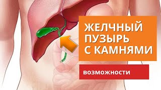 Желчные камни без операции: 5 важных моментов для контроля и натуральная методика