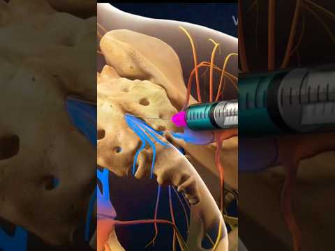 БЛОКАДА - ЛЕЧЕНИЕ БОЛИ СПИНЫ l Caudal epidural  injection #блокада #остеохондроз #лечение #спина