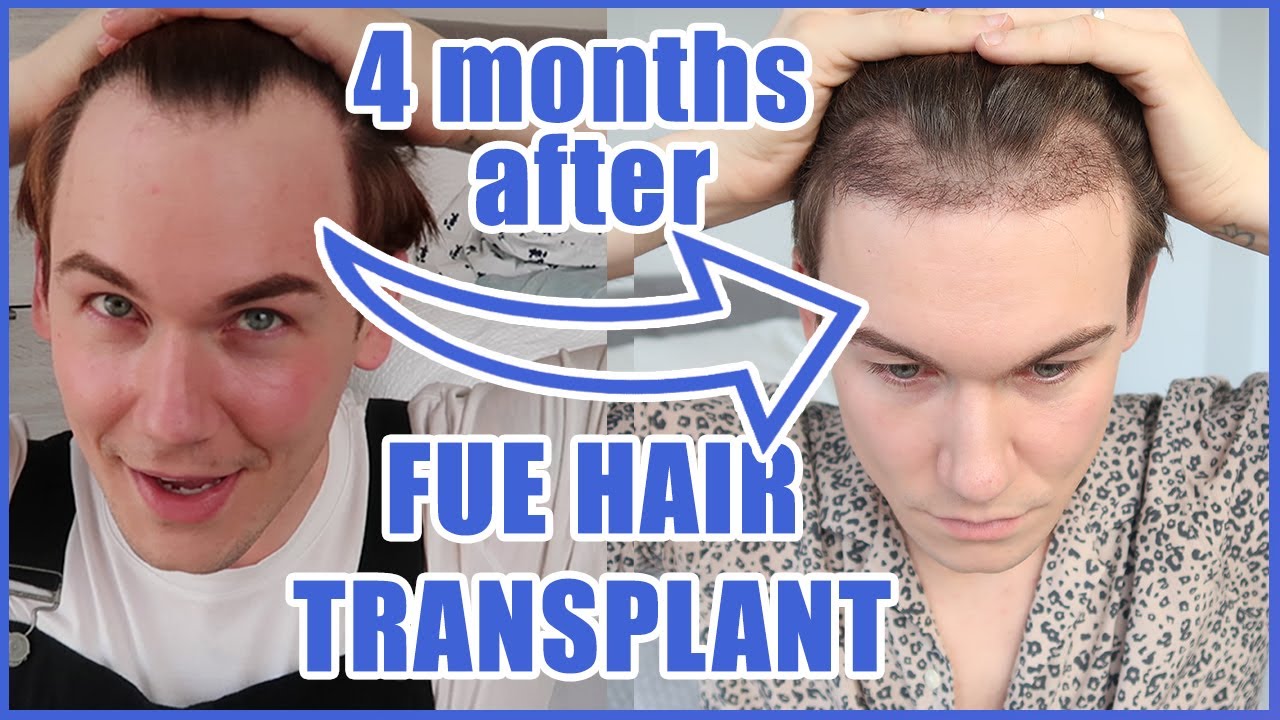 Hair Transplant Recovery Timeline  0  14 Months Photos