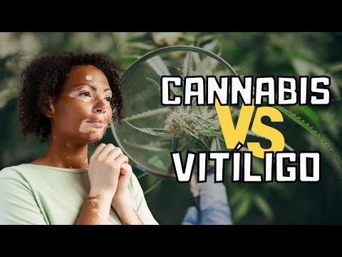 Tratamiento para el VITILIGO con CANNABIS