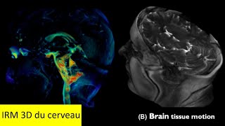 IRM 3D du cerveau