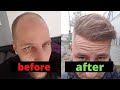From day 0 to month 12  hair transplant turkey comparison