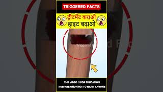 Limb lengthening explained in hindi factsinhindi ?हाइट बढ़ाओ? amazingfacts triggeredfacts shorts