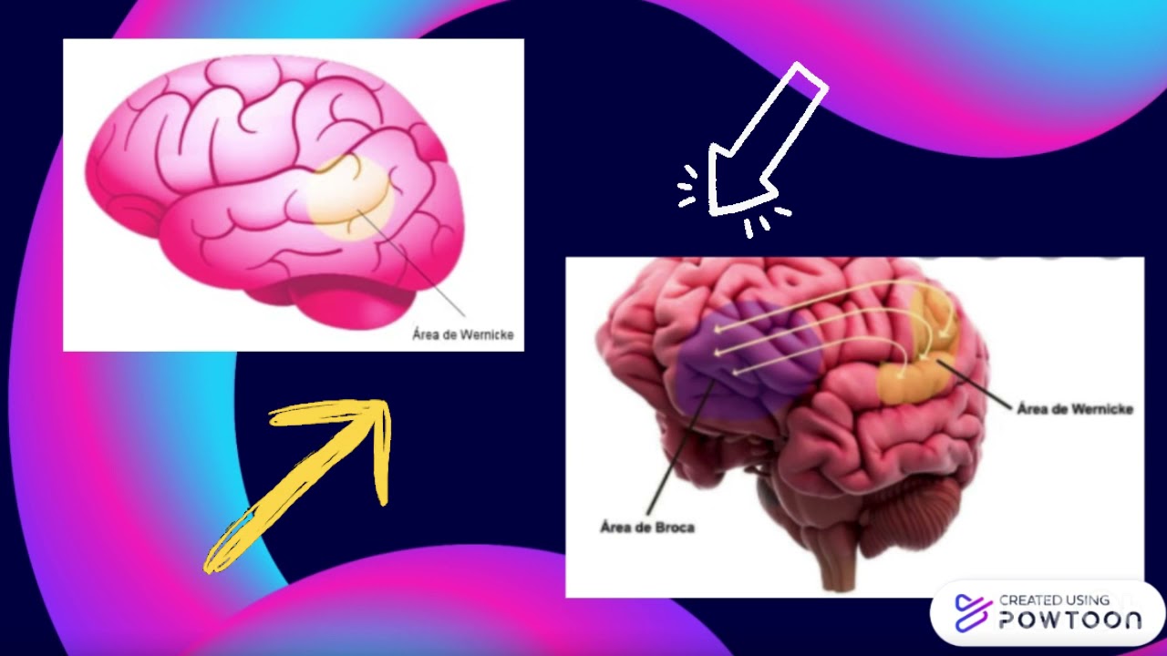 Caso Clínico Neuro (Afasia de Wernicke) YouTube Caso Clínico Neuro (Afasia de Wernicke) YouTube