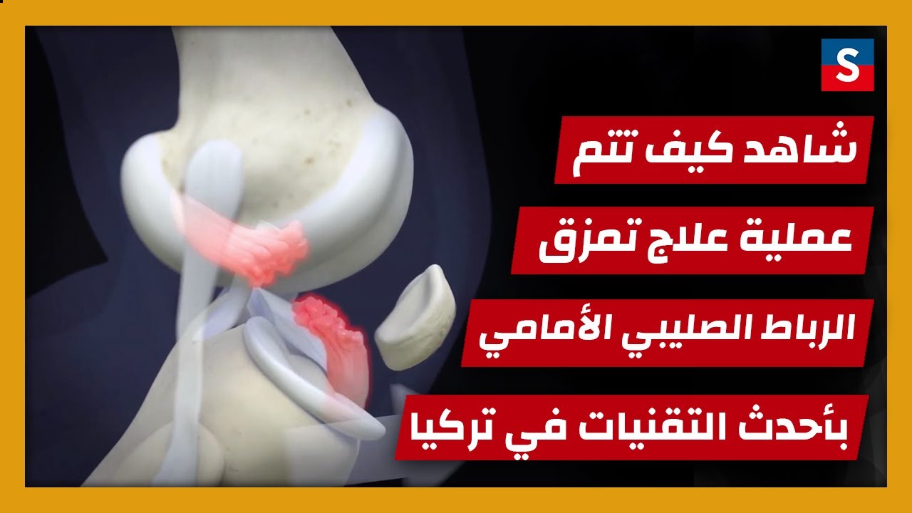 شاهد كيف تتم عملية علاج تمزق الرباط الصليبي الامامي