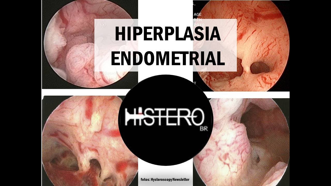 Hiperplasia Endometrial