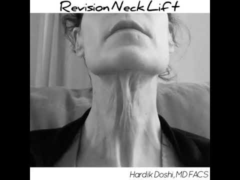 Revision Neck Lift
