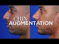 What is a chin augmentation or chin surgery  dr  moustafa mourad  manhattan plastic surgeon