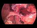 Laparoscopic hiatal hernia repair and Nissen Fundoplication