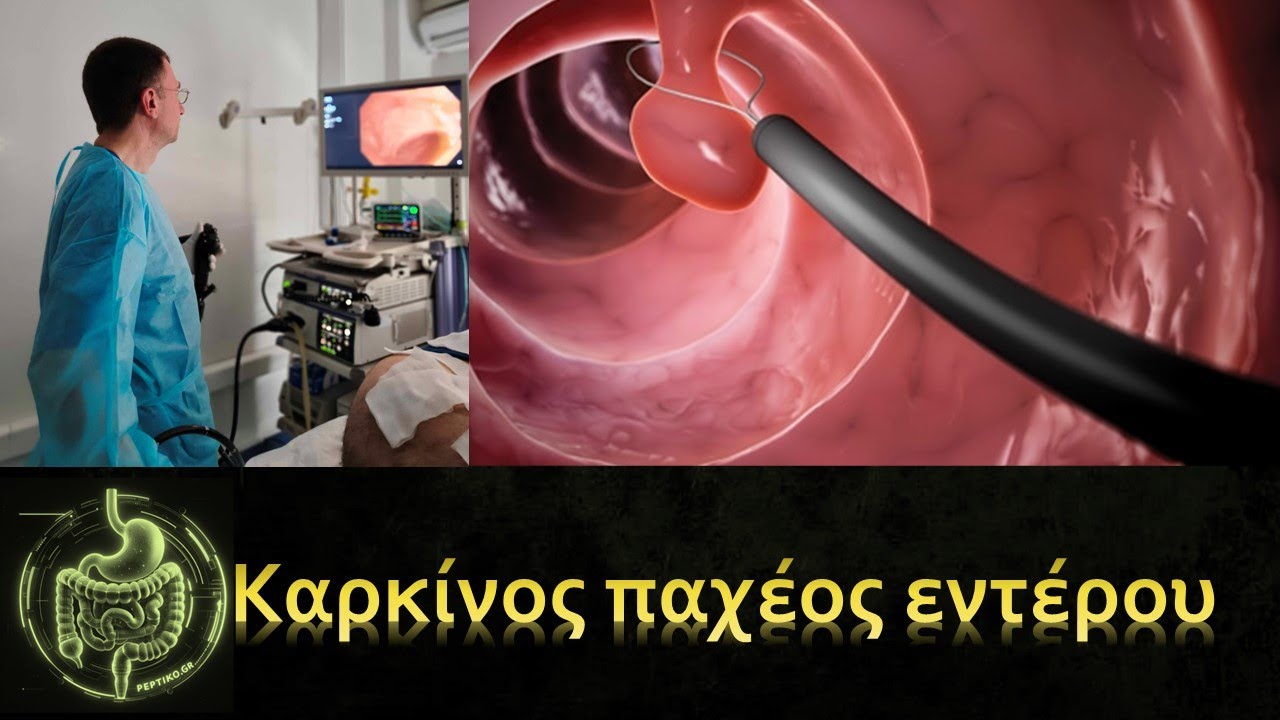 Παράγοντες κινδύνου για καρκίνο παχέος εντέρου - peptiko.gr