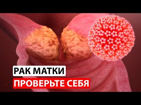 Видео: Плохие клетки плоского эпителия?