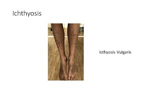 Ichthyosis by House Job 17 views 1 month ago 4 minutes, 49 seconds