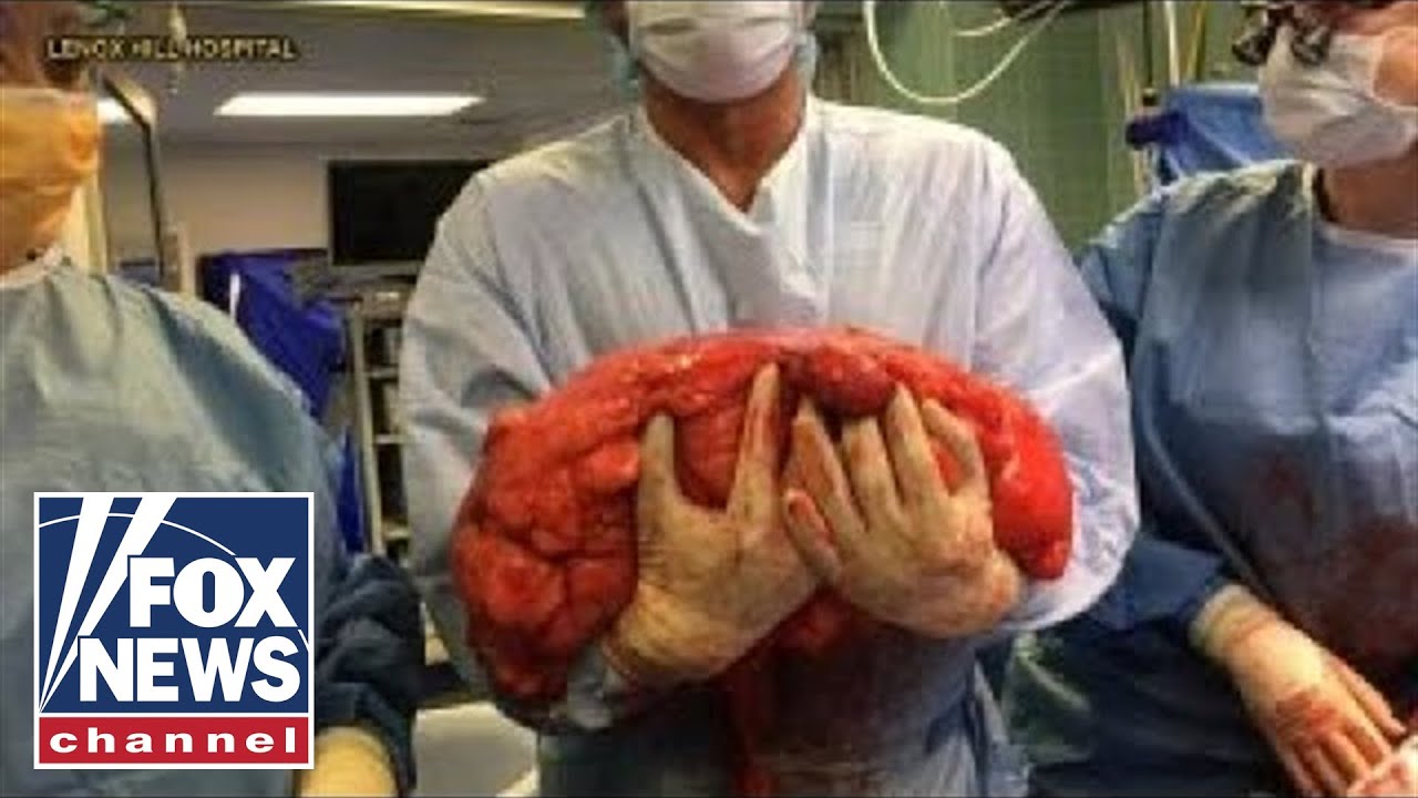 Man's "beer belly" turned out to be a 30-pound tumor