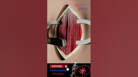 Tracheostomy procedure 🫁 tracheotomy surgery Annotated Version. #medicalanimation