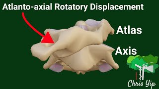 Cock Robin Deformity in Atlanto-axial Rotatory Displacement (AARD) (Animated)