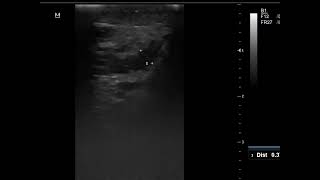 Case 1126 CASE ISCHEMIC ORCHITIS
