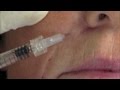 Rejuvenecimiento facial. Tratamiento con Restylane en Beyou Medical Group. Capitulo 3