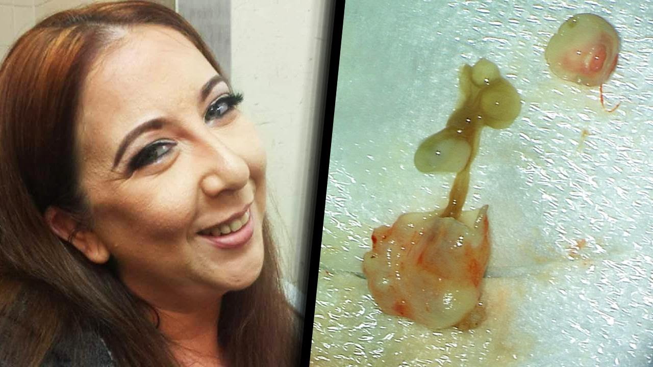 Woman's Brain Cancer Scare Turns Out to Be Tapeworm - Inside Edition thumbnail