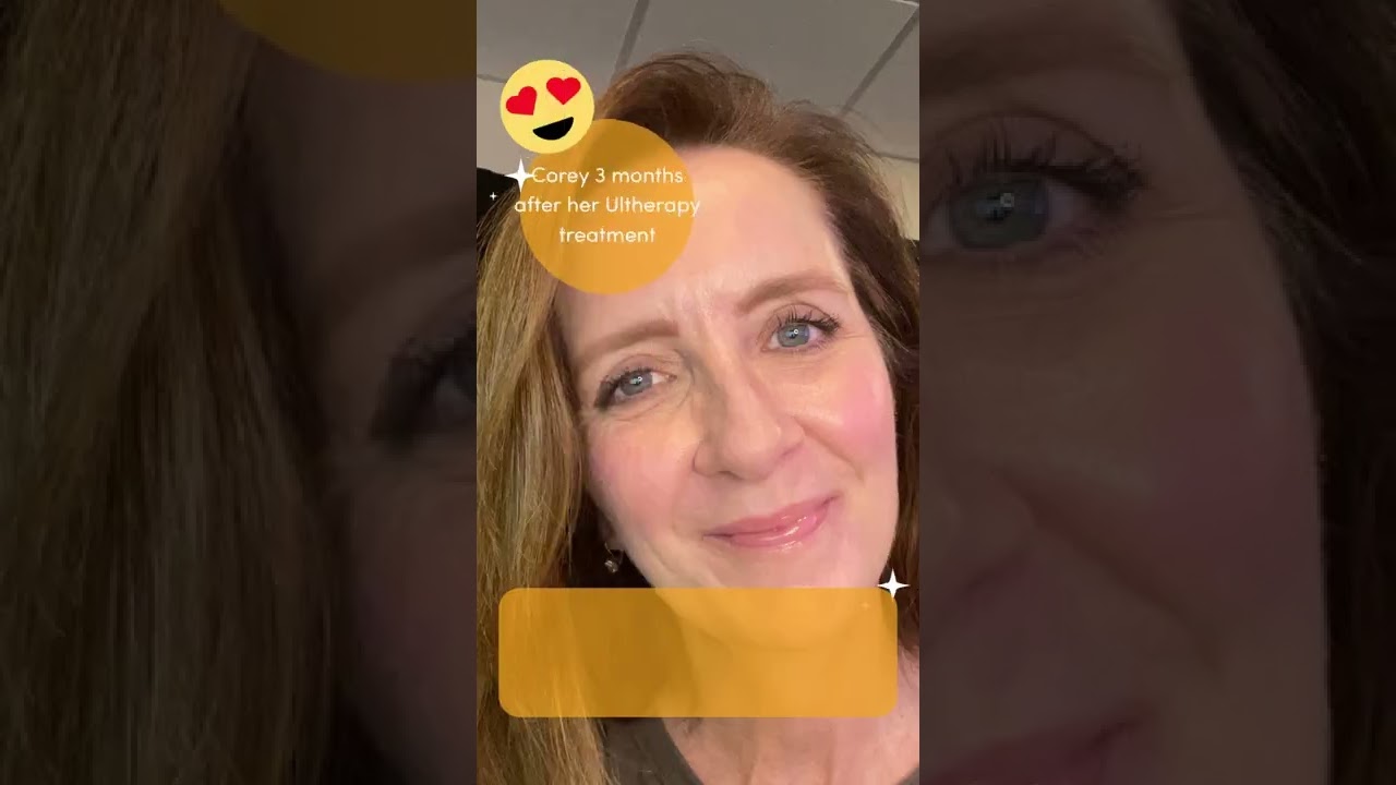 Как выглядят и ощущаются результаты Ultherapy спустя 3 месяца? | La Jolla Cosmetic