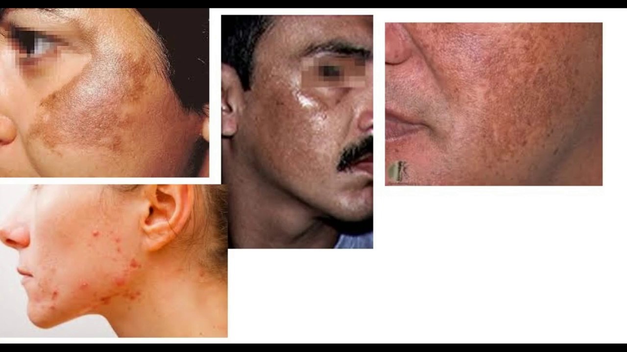 चेहरे की झाइयों का उपचार Homeopathic treatment for skin pigmentation