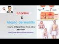 Eczema(atopic dermatitis) causes , factors &amp; TREATMENT