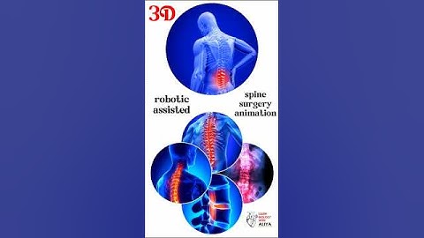 robotic assisted spine surgery animation #spine #health #medical #animation #3d #short